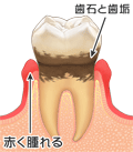 歯周病の進行の様子02