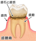 歯周病の進行の様子01